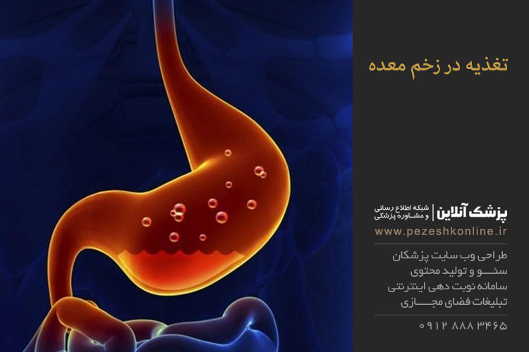 تغذیه در زخم معده