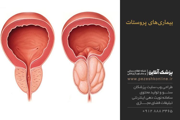 بیماری‌های پروستات