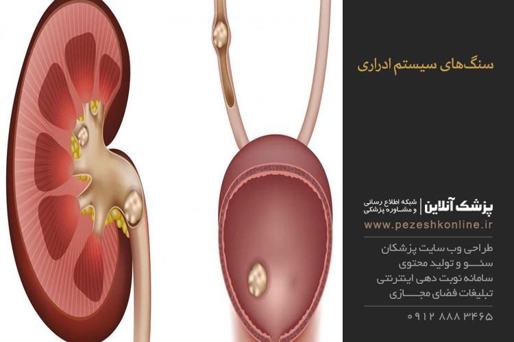 درمان سنگ های دستگاه ادراری