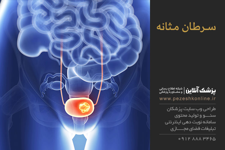 درمان سرطان مثانه