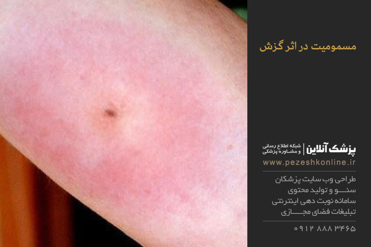 گزیدگی و مسمومیت