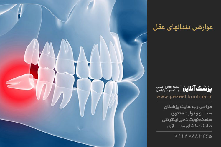 دندان عقل نهفته