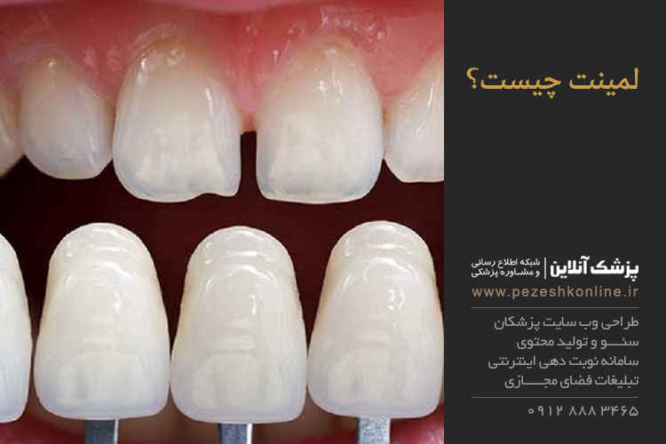 انواع لامینت دندان