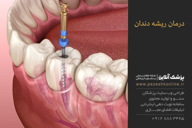 درمان ريشه دندان