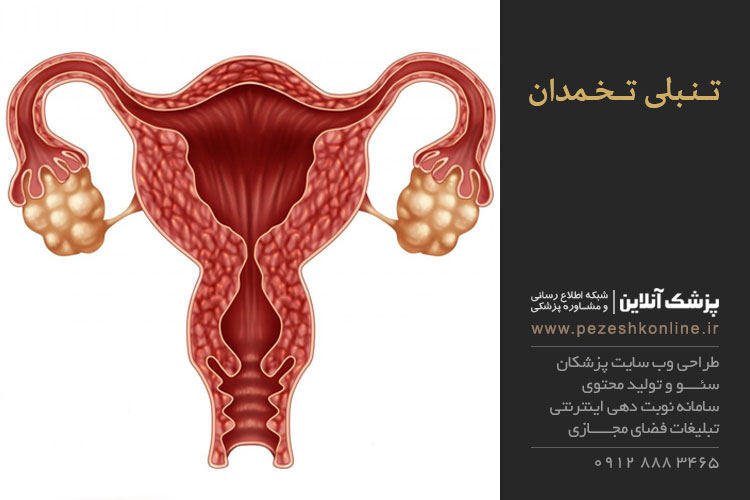 تنبلی تخمدان