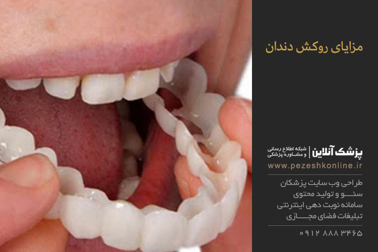 مزایای روکش دندان