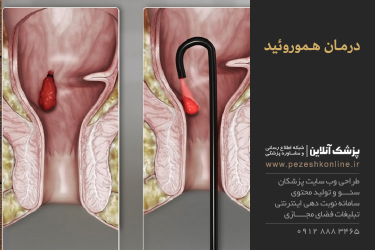 بواسیر یا هموروئید