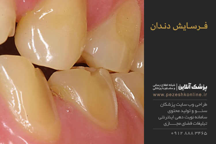 علل فرسایش دندان