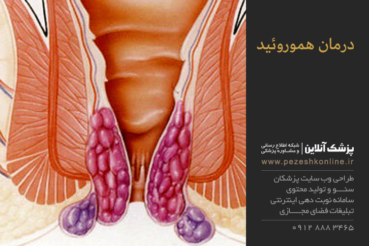 هموروئید چیست و چگونه درمان میشود