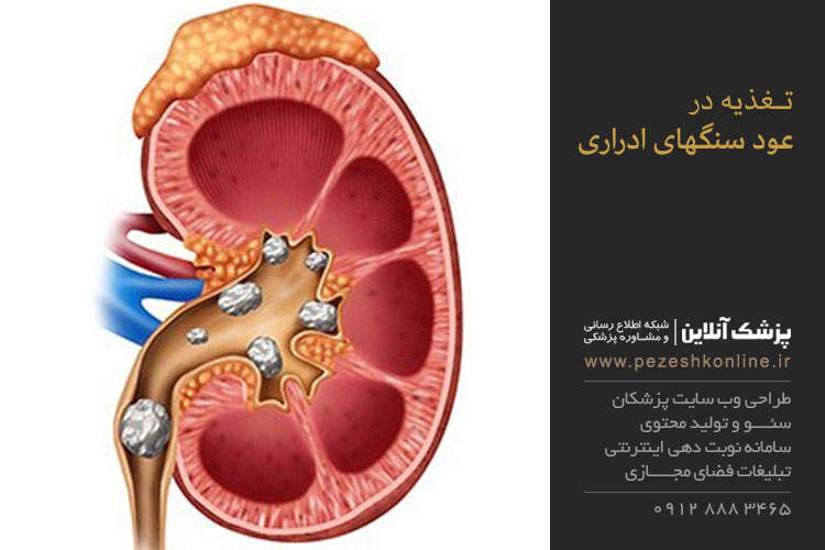 تاثیر روزه داری در عود سنگهای ادراری